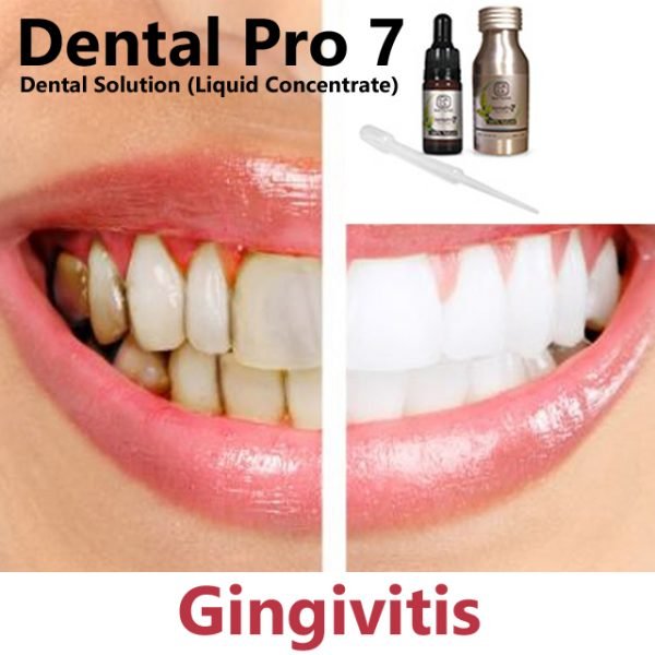 Receding Gums Gingivoplasty