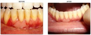 Pictures Of Healthy Gums