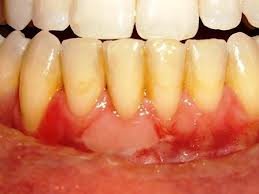 What Do Unhealthy Gums Look Like